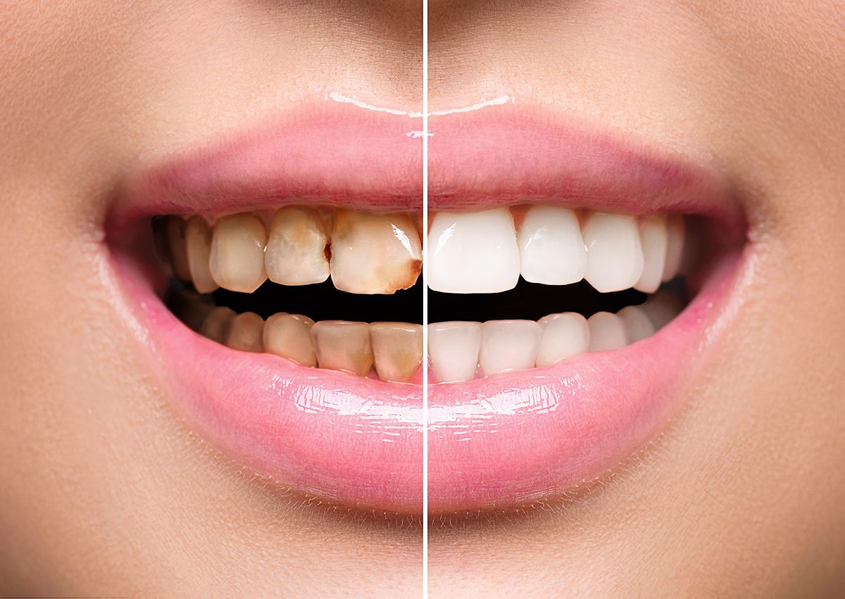 Cosmetic dentistry smile makeover