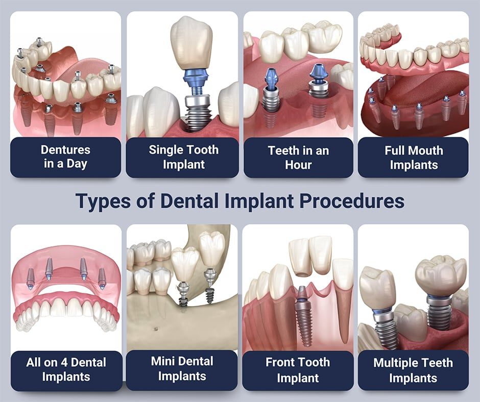 Dental implant procedure