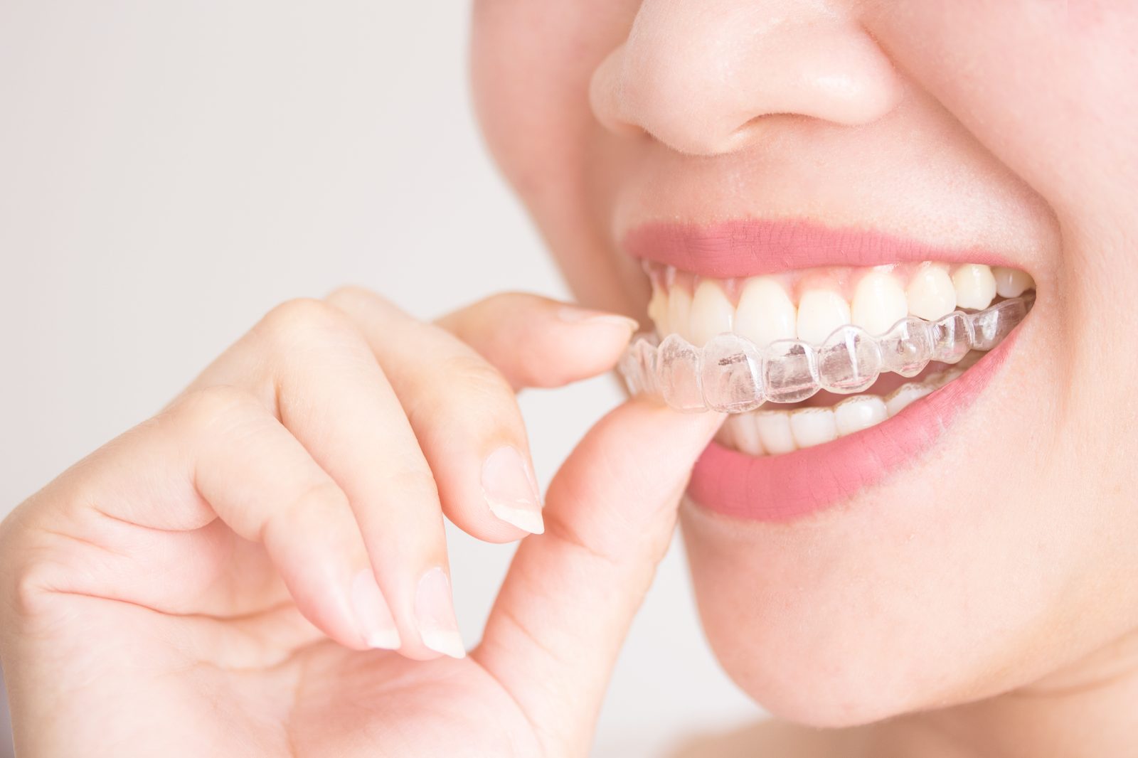 Invisalign clear aligner teeth straightening