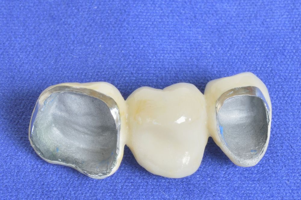 Restorative dentistry dental crowns
