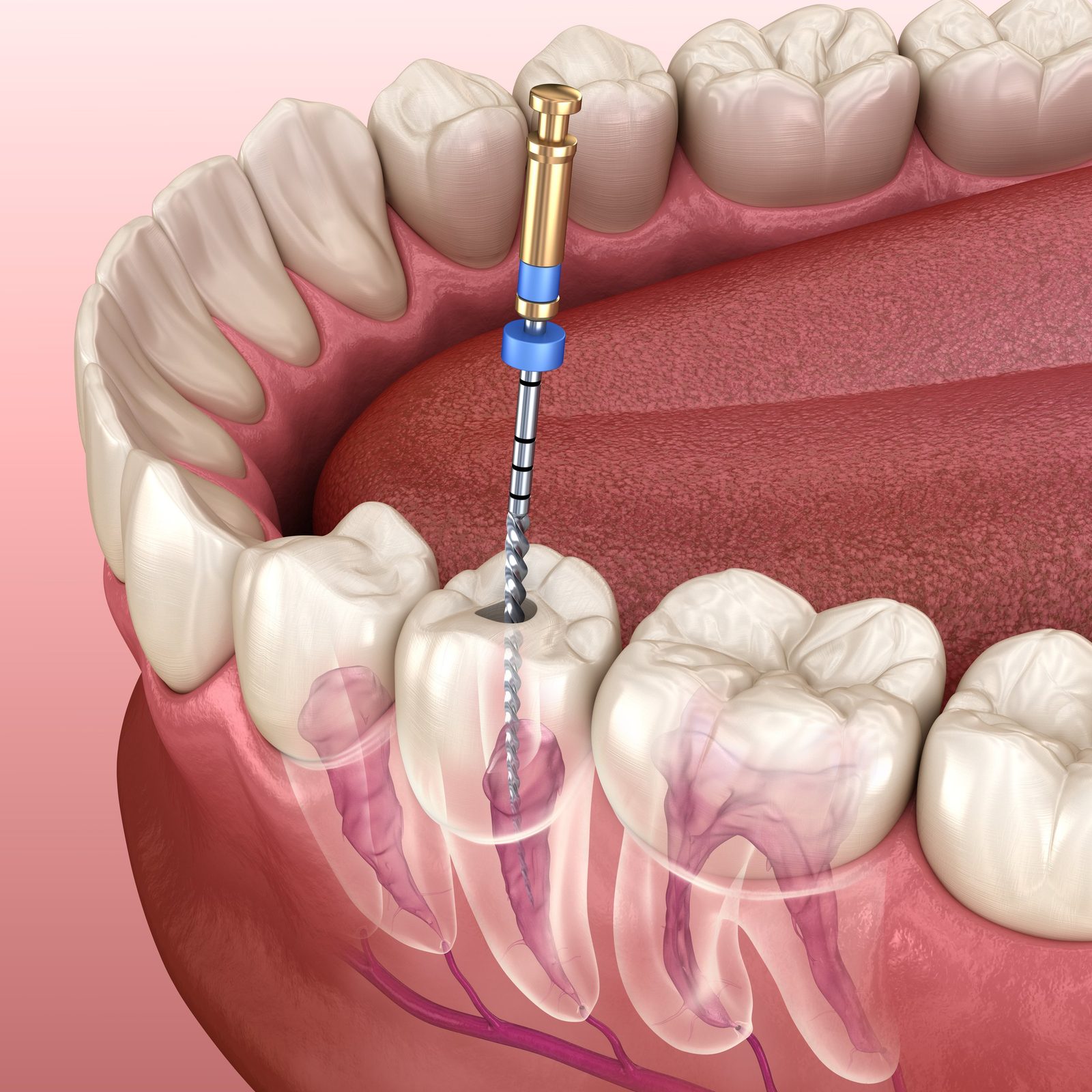 Root canal treatment of a tooth
