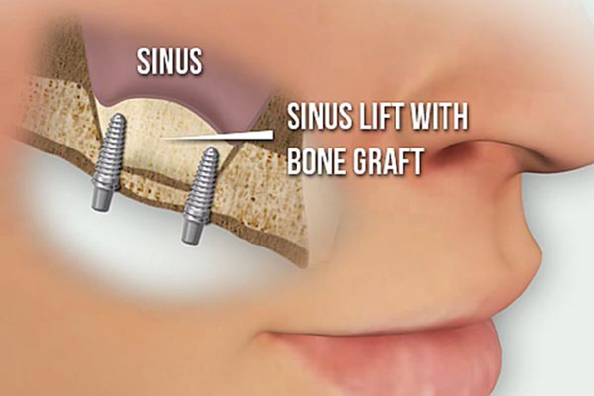 Sinus lift dental implant surgery